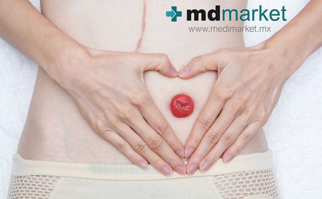 Respuestas a dudas comunes que tienen los nuevos ostomizados: Mdmarket, Medimarket